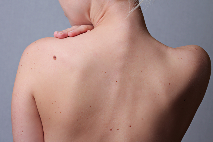 Is It Time to Worry Signs That You Should Get That Mole Checked Out ASAP